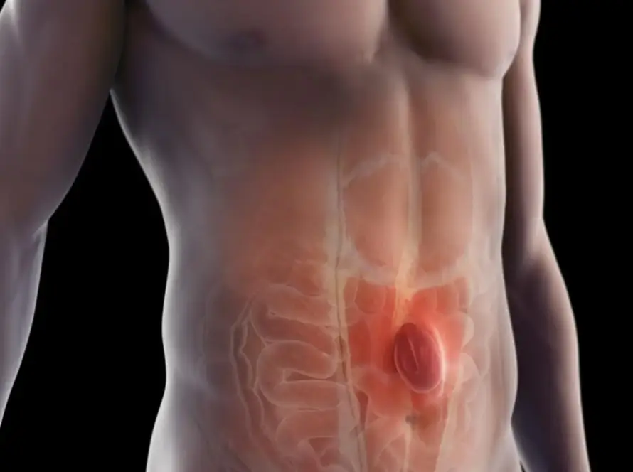hernia abdominal
