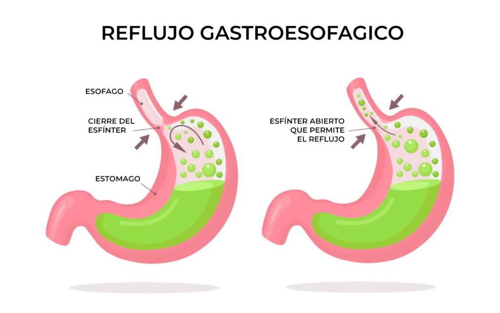 reflujo gastroesofagico
